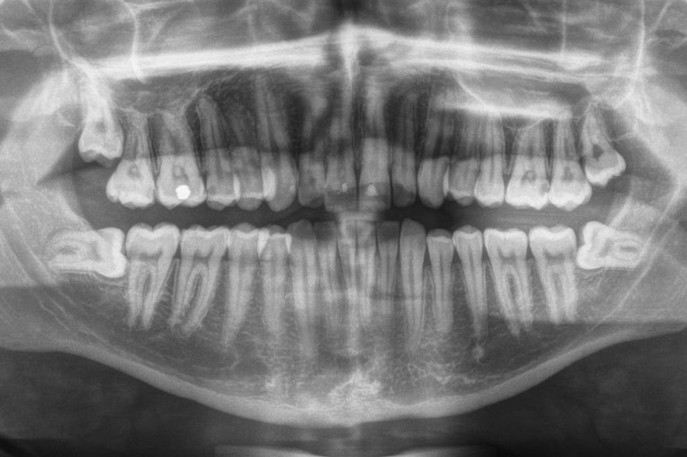 Operative Entfernung Von Weisheitsz hnen Mkg chirurgie stamm de
